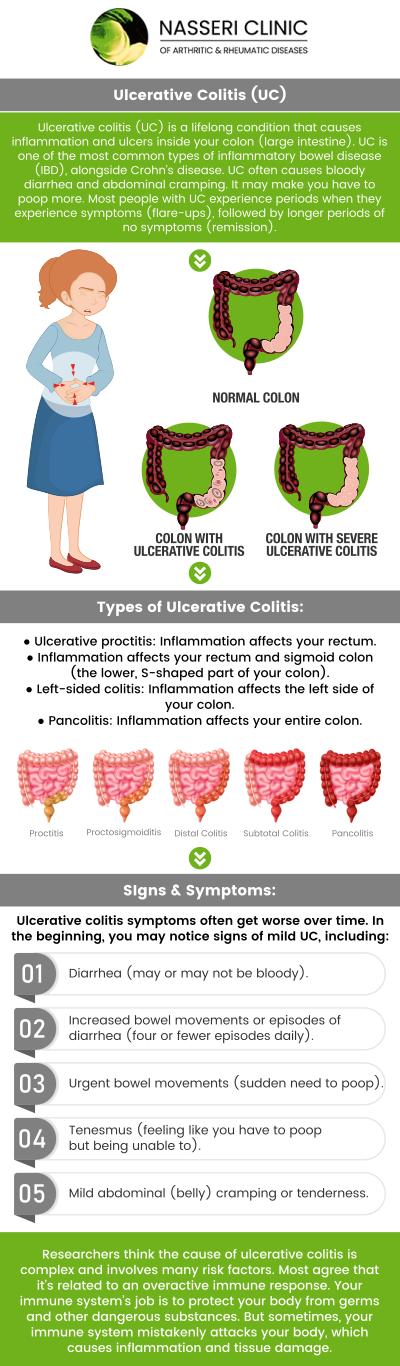 The symptoms of ulcerative colitis (UC) can range from mildly inconvenient to severely disruptive, significantly affecting daily life. Intravenous treatment for UC often involves administering biologic medications or corticosteroids directly into the bloodstream. For professional care, visit Dr. Nasseri, MD, and his team at Nasseri Clinic of Arthritic and Rheumatic Diseases. For more information, contact us or visit us online to book an appointment. We have convenient locations to serve you in Catonsville, Glen Burnie, Columbia, Rosedale, Edgewater, and North Baltimore, MD! The symptoms of ulcerative colitis (UC) can range from mildly inconvenient to severely disruptive, significantly affecting daily life. Intravenous treatment for UC often involves administering biologic medications or corticosteroids directly into the bloodstream. For professional care, visit Dr. Nasseri, MD, and his team at Nasseri Clinic of Arthritic and Rheumatic Diseases. For more information, contact us or visit us online to book an appointment. We have convenient locations to serve you in Catonsville, Glen Burnie, Columbia, Rosedale, Edgewater, and North Baltimore, MD!